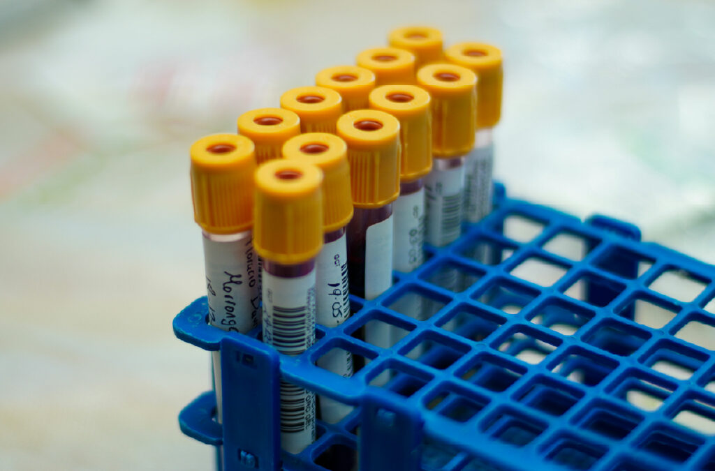 Homo sapiens isolate H1321 BCR/ABL variant-p210 fusion protein mRNA, partial cds (PZ329996)