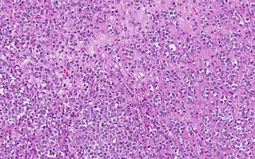 Nueva Publicación en Cáncer de Mama